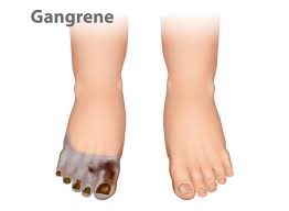 Image result for toe black diabetes