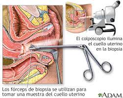 Biopsia Dirigida Por Colposcopia