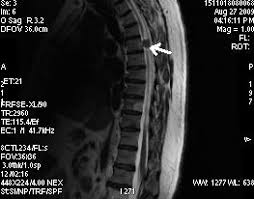 Rmn coloana lombar, se face cu bilet de trimitere? Cazul 13 Meningiom Medular Medimar Imagistic Services Rmn Constanta Ct Constantadimar