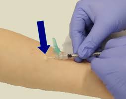 Injectia Intradermica