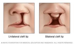 Image result for Cleft Lip