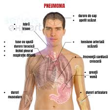 Acesta se produce prin patrunderea aerului in spatiul dintre plaman si peretele toracic, care genereaza astfel o presiune ce poate comprima plamanul, impiedicand participarea acestuia la respiratie. Durere In Piept Tuse Dureri Articulare Durerea In Piept Arcadia Spitale Si Centre Medicale