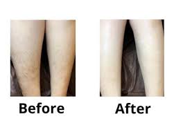 With laser hair removal for real results you need a real laser clinic with real lasers. Laser Hair Removal Dermacore Telford Shropshire