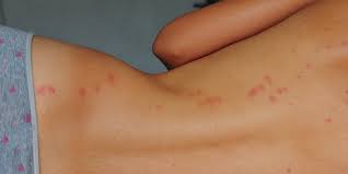 Call orkin to get rid of bed bugs and other pests. Xif78xwfztfpmm