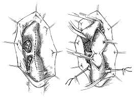 Nehler, jose lopez, mohammad h. Coarctation Of The Aorta Circulation