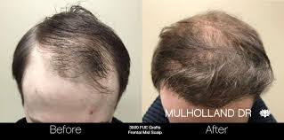 Although, this is actually a benefit because the gradual return of hair to previously thinning areas will look perfectly natural and it is your own natural hair. Toronto Fue Follicular Unit Extraction Hair Transplant