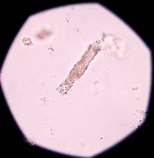 Image result for Urinary Cast