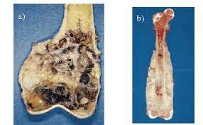 If you feel pain in leg, hip or hip area. Forms Of Bone Tumors Osteosarcoma A Ewing S Sarcoma B Download Scientific Diagram