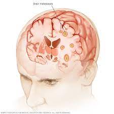 Life expectancy in patients with brain metastases depends upon the variety of factors. Brain Metastases Symptoms And Causes Mayo Clinic
