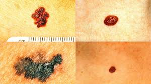 Do it when you have time to examine your skin asymmetry: What Does Melanoma Look Like Skin Cancer Youtube