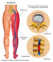 Pin On Spine Stuff