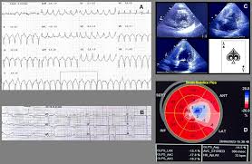 Apical hypertrophic cardiomyopathy (Yamaguchi syndrome) with ventricular  tachycardia manifestation: Case report and multidisciplinary approach