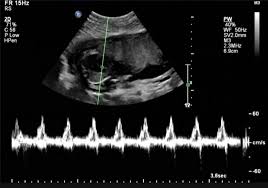 Also known as the ramzi theory, this method of gender prediction is all based on the position of the placenta. Fetal Ultrasound Image Gallery Fetal Pictures Of Ultrasound