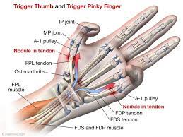 The flexor digitorum profundus muscle is found in the deep layer of the anterior forearm. Tendon Rupture Following Trigger Finger Release Medmovie Com