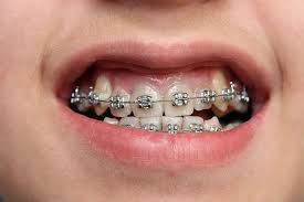 Can braces help you in the office and the dating scene? Free Dental Braces Can My Child Get Them Ridgway Dental Wimbledon Ridgway Dental Wimbledon