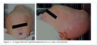 Image result for Cephalhematoma
