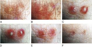 Image result for ant bite