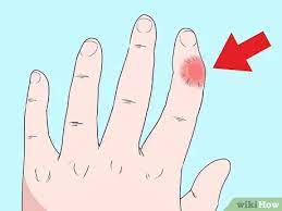 Notice if your injured finger is abnormally bent, painful, and won't move. Easy Ways To Fix A Dislocated Finger 12 Steps With Pictures