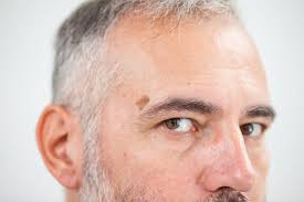 It is made of extra oil glands in the skin. Is My Birthmark Dangerous Hollywood Dermatology