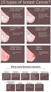 Most breast cancers start in the epithelial cells in the lining of the organs and tissues. What Is Breast Cancer Pink Ribbon Pakistan