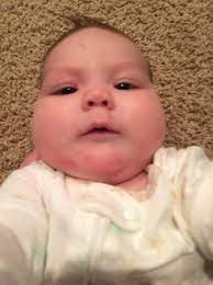 Rash After Sweet Potatoes Babycenter