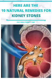 Click Here To Know The 10 Natural Remedies For Kidney Stones In 2020 Kidney Stones Remedy Passing Kidney Stones Kidney Stones