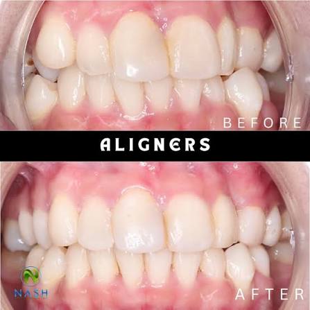 Before and after in-house aligner case one by Klinik Pergigian Nash