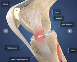The anterior cruciate ligament (acl) is one of the 4 major ligaments of the knee. The Do S And Don Ts After Acl Mcl Tears Surgery Heiden Orthopedics