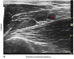 Image result for Axillary Nerve Block