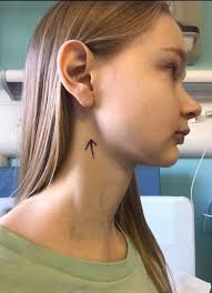 Potential causes of a lump on the neck include swollen lymph nodes, acne, and cysts. Woman Left With 10 Inch Scar After Neck Lump From Braces Turns Out To Be Cancer Mirror Online