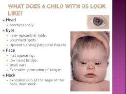 Some have congenital heart disease. Flat Nasal Bridge And Epicanthal Folds Strabismus Amblyopia Leukocoria Ppt Video Online Download