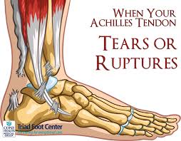 What Happens When Your Achilles Tendon Tears Or Ruptures Http Www Triadfoot Com 2015 08 26 When Your A Achilles Tendonitis Achilles Tendon Ruptures Achilles