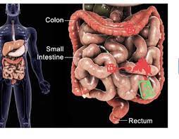Inflammatory Bowel Disease Flashcards Quizlet