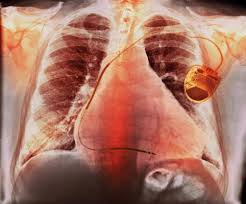 Image result for Cardiac Resynchronization Therapy