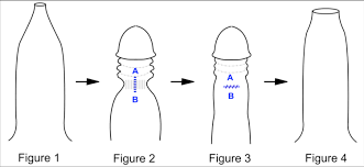 Circumcision Wessex Andrology