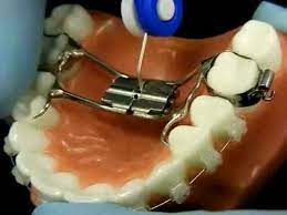 Bracesquestions Com Orthodontic Jaw Expander How To Turn Dental Braces Orthodontics Palate Expander