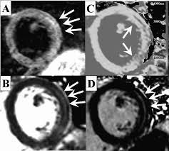 The possible pathophysiology and proposed guideline for diagnosis. 086 The Detection Of Acute Myocarditis Using Cardiovascular Mri A Clinical Study Comparing T1 Mapping T2 Weighted And Late Gadolinium Enhancement Imaging Heart