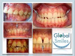You have a difficult time chewing your food. Do I Need Braces Global Smiles Blog