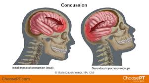 Image result for Concussion