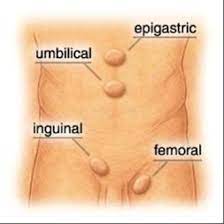 Hernias Q A With Mr Paul Flora Highgate Private Hospital