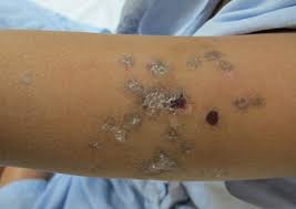 Systemic lupus erythematosus (sle) is a chronic inflammatory disease that has protean manifestations and follows a relapsing and remitting course. Vesiculobullous Diseases In Relation To Lupus Erythematosus Ccid