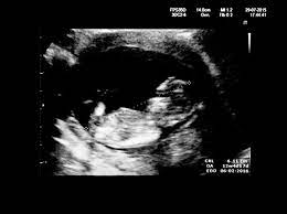Women's imaging conducts a detailed risk assessment for your baby in accordance with the fetal medicine foundation. 12 Week Pregnancy Dating Scan What Will It Tell Me Madeformums