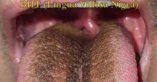 Image result for black hairy tongue symptoms