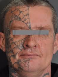 Tattoo removal results green tattoos blue tattoo lightening tattoo non permanent tattoo tattoo eraser think tattoo. Before And After Images Newcastle Tattoo Removal S Results