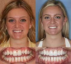 Check spelling or type a new query. 6 Upper Porcelain Veneers Before And After Photos Dr Ginger Price Ph 602 468 1135 Www Gingerpricedds Com Veneers Teeth Dental Veneers Dental Cosmetics