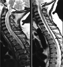 Image result for Myelitis