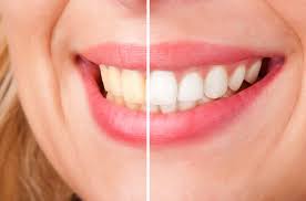 Check spelling or type a new query. Best Way To Whiten Teeth Schmakel Smile Design Toledo Oh