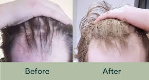 Saw palmetto, an ingredient in nutrafol, helps target dht, the hormone responsible for jon's hair thinning, dr. Success Story Leo S Hair Regrowth Manual