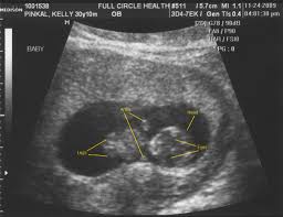 (it will also reveal your baby's sex.) results are usually available in a week or two. 10 Week Ultrasound Kelly S Blog