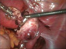 Alles über endometriose und adhäsionen! Endometriose Wikipedia